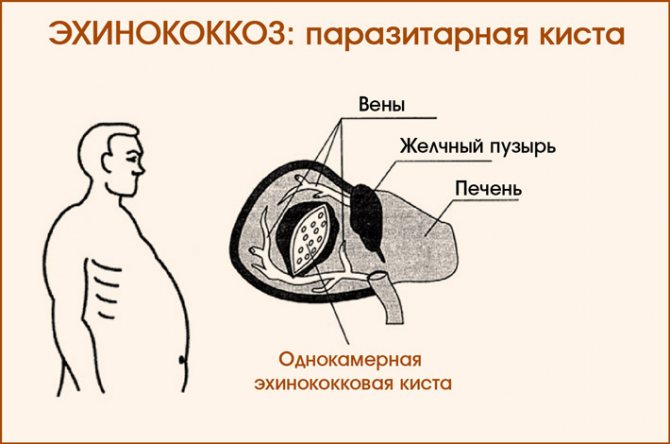 Эхинококкоз: паразитарная киста