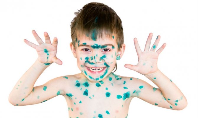 как начинается ветрянка у детей