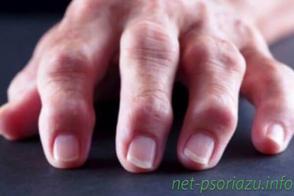 Как развивается болезнь