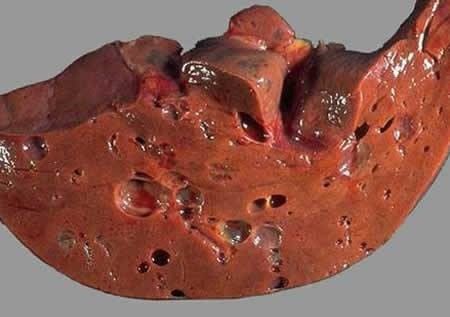 Кисты в печени