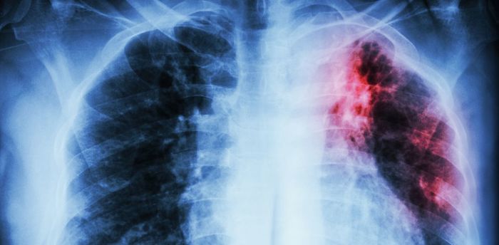 Лимфоузлы на голове. Расположение, схема, фото, где находятся. Симптомы воспаления, лечение