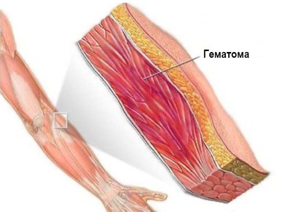 Мази от ушибов и растяжений. Список недорогих обезболивающих средств, цены