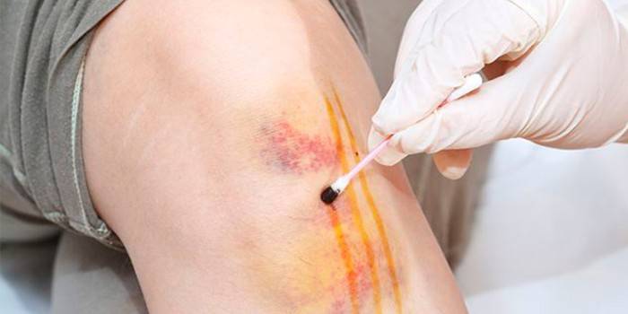 Нанести на синяк йодную сетку