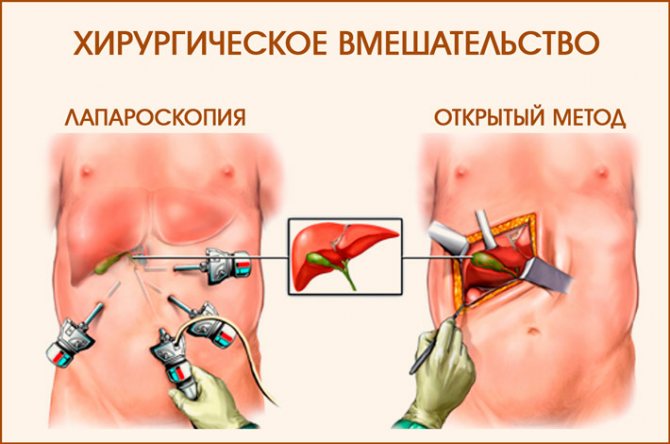Операция на печени