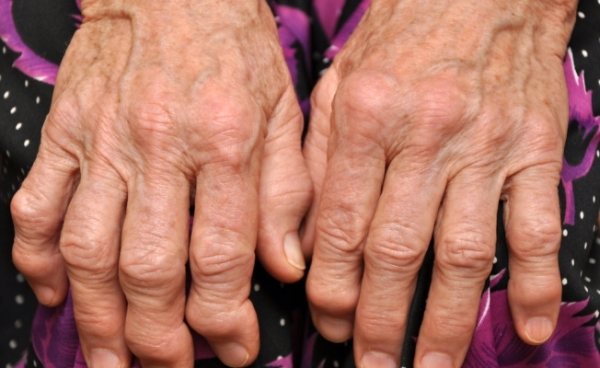 осложнения псориатического артрита