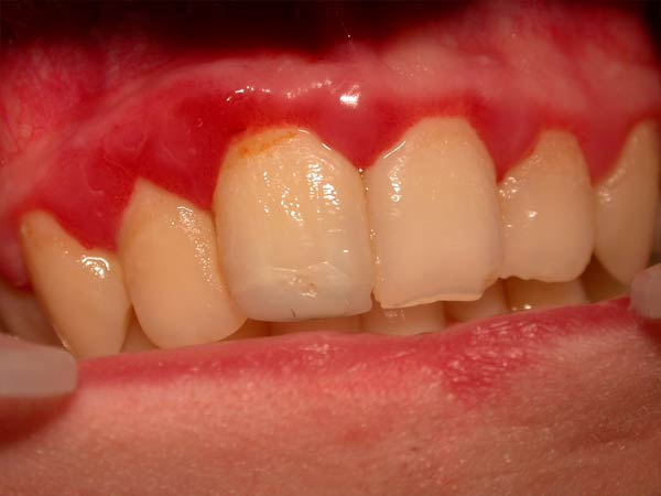 пародонтоз