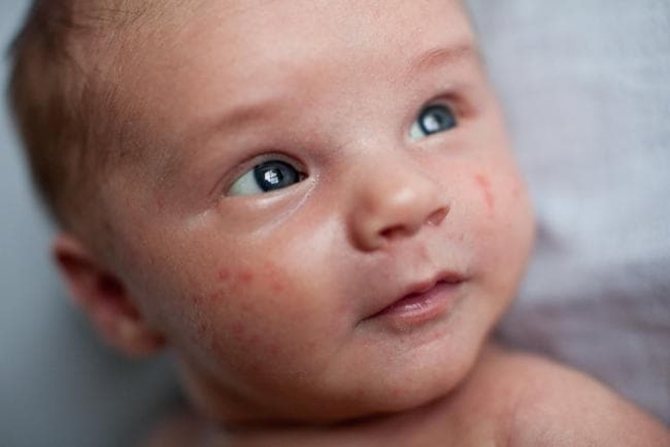 первые признаки ветрянки у ребенка