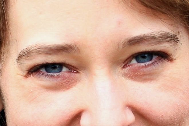 Причины мешков под глазами у женщин