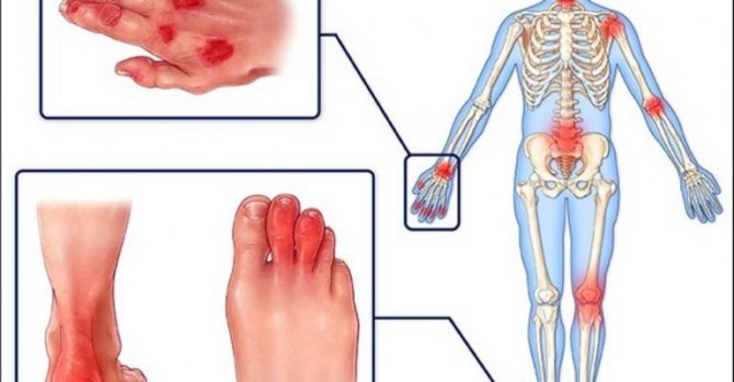 псориатический артрит