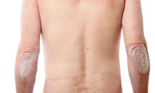 псориатический артрит