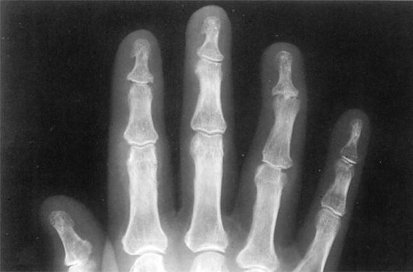 Рентгенологическое исследование сустава