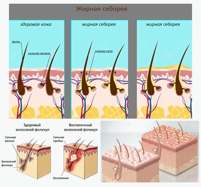 Себорейный дерматит