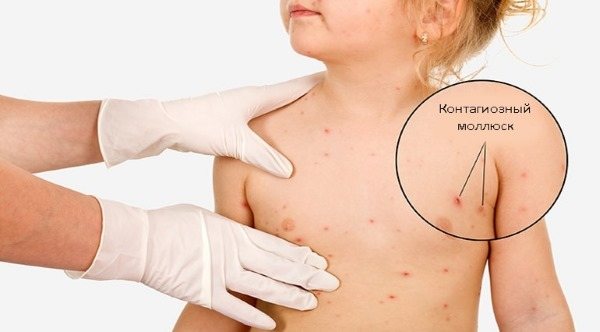 Сыпь на теле у ребенка. Фото с пояснениями: в виде прыщиков, мелкая, чешется, красная, без температуры, зуд, аллергическая. Что это может быть