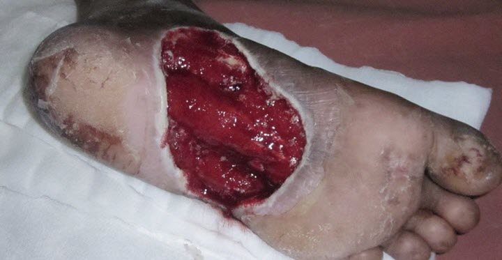 Трофическая язва