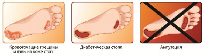 Трофические язвы на ногах. Фото, лечение, почему образуются, чем мазать