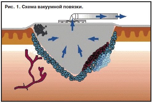 Трофические язвы на ногах. Фото, лечение, почему образуются, чем мазать