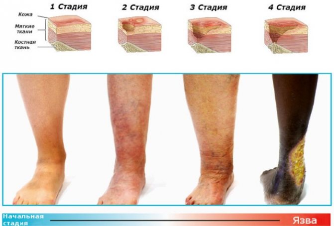 Трофические язвы на ногах. Фото, лечение, почему образуются, чем мазать