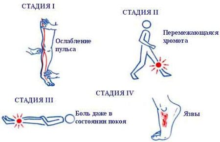 Трофические язвы на ногах. Фото, лечение, почему образуются, чем мазать