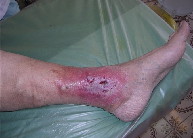 Трофические язвы на ногах. Фото, лечение, почему образуются, чем мазать