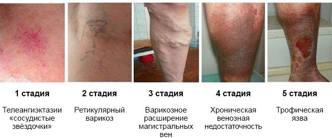 Трофические язвы на ногах. Фото, лечение, почему образуются, чем мазать