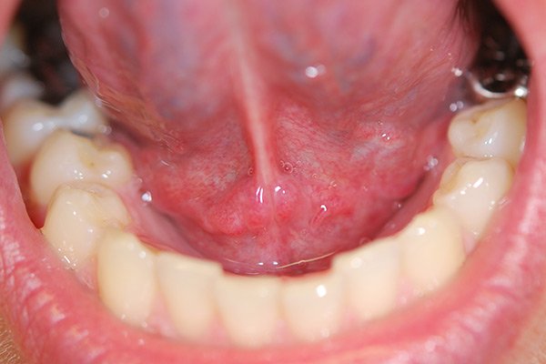 Воспаление слюнной железы